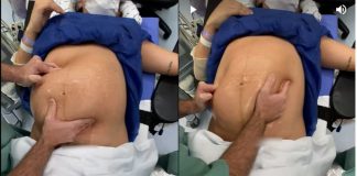 Vídeo impressionante mostra médico virando bebê na barriga da mãe antes do parto