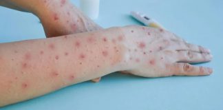 Vigilância registra caso suspeito de MPOX na região de Presidente Prudente