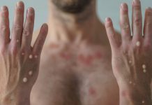 Oeste Paulista chega a 12 casos de mpox, com mais três casos registrados em Presidente Epitácio