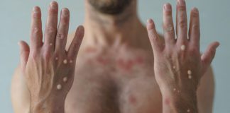 Vigilância Epidemiológica confirma primeiro caso positivo de monkeypox em Prudente