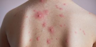 Caso suspeito de Mpox em Prudente é descartado paciente teve catapora