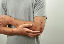 Secretaria de Saúde de Presidente Prudente confirma sete casos de Mpox