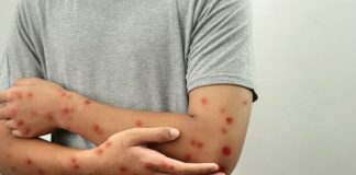 Secretaria de Saúde de Presidente Prudente confirma sete casos de Mpox