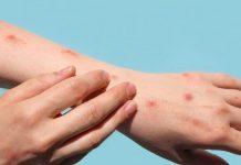 Prudente registra mais dois casos de contaminação por Mpox