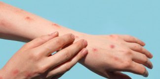 Prudente registra mais dois casos de contaminação por Mpox