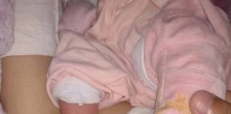 Bebê que teve o pé queimado ao fazer teste do pezinho continua internada em Prudente