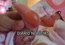 Bebê sofre queimaduras ao fazer o “Teste do Pezinho” em Panorama