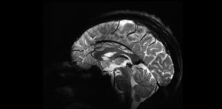 Mulher morre após aneurisma cerebral romper durante orgasmo, na Sérvia