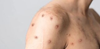 Mpox em Presidente Prudente: Unimed indica como reconhecer sinais e prevenir a transmissão