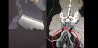 Homem tem prolapso retal após passar mais de 30 minutos sentado em vaso sanitário na China