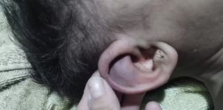 Bebê de um ano com sarna é resgatado após sofrer tortura do pai em Presidente Prudente