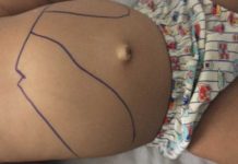 Presidente Prudente confirma terceiro caso de leishmaniose visceral em 2025 e amplia combate à doença