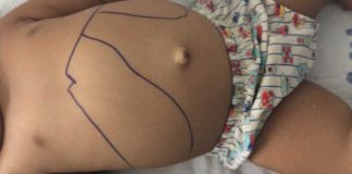 Presidente Prudente confirma terceiro caso de leishmaniose visceral em 2025 e amplia combate à doença