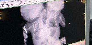 Caso raro de gêmeas siamesas leva TJ/SP a autorizar interrupção de gestação em Presidente Prudente