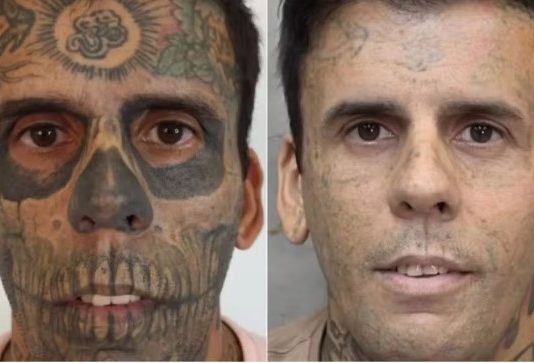 Homem mais “Mais tatuado do Brasil” passa por 6ª sessão de remoção antes de lançamento de livro sobre vida religiosa